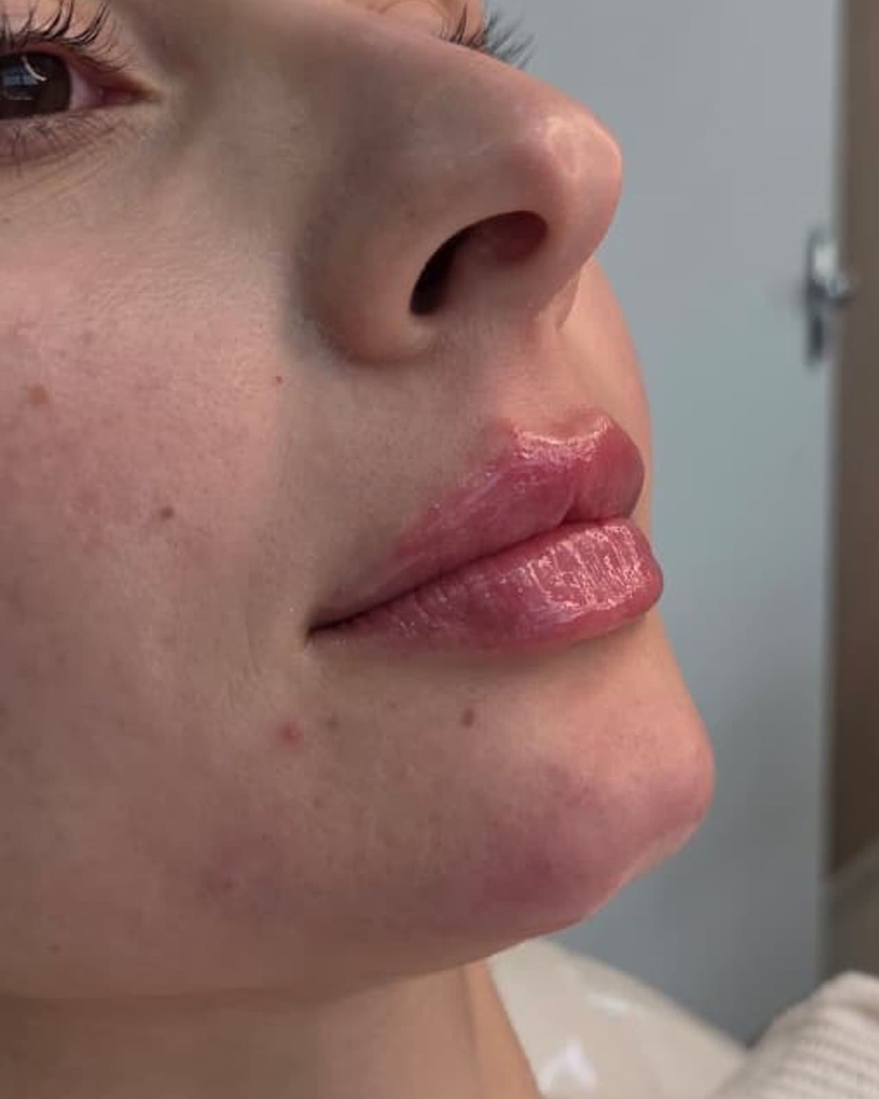 Método Vi-Lips