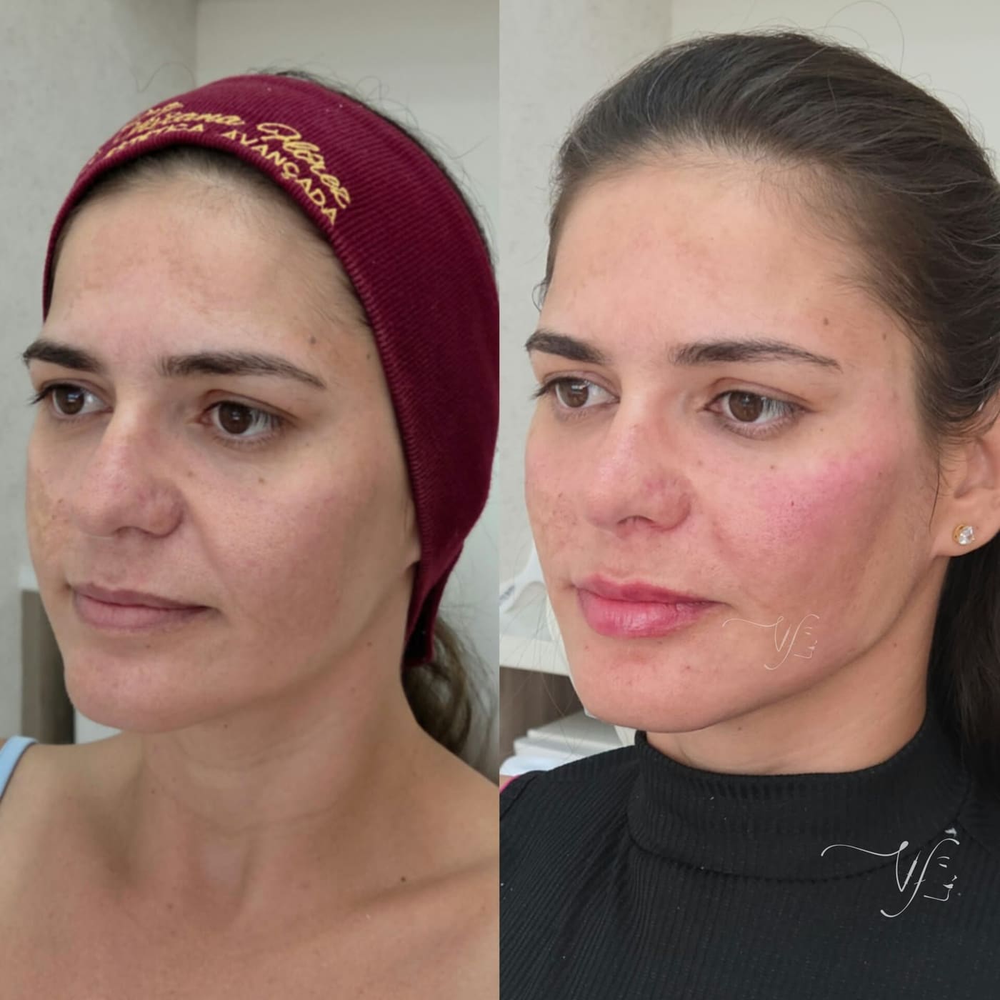 Harmonização Facial